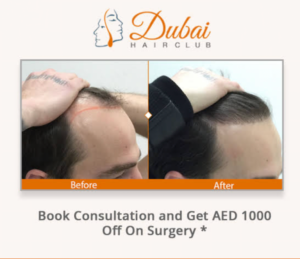 best hair transplant surgeon in Dubai